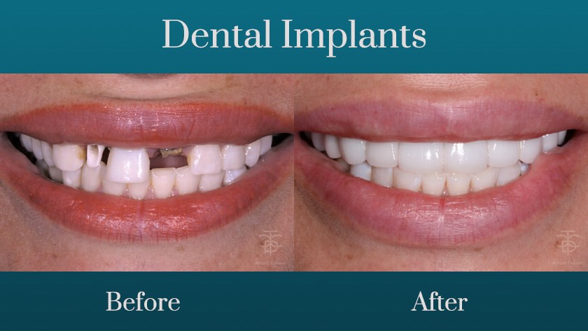 dental implants before and aft